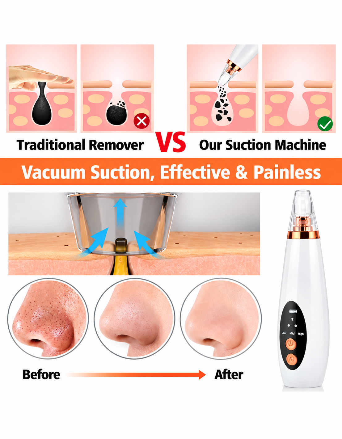 Blackhead Remover Vacuum – 3 Suction Levels, 6 Heads, Rechargeable